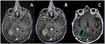 Preoperative Stereotactic Radiosurgery for Brain Metastases